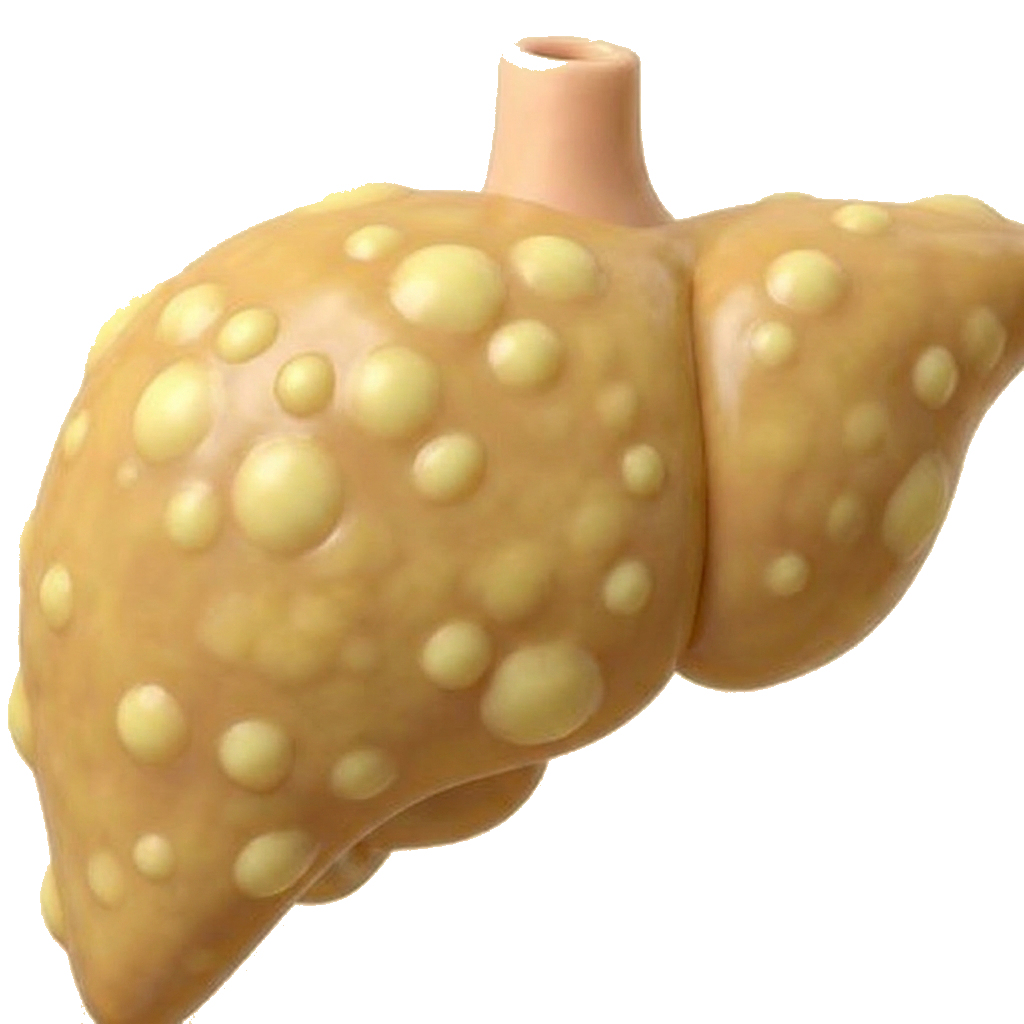 fatty liver